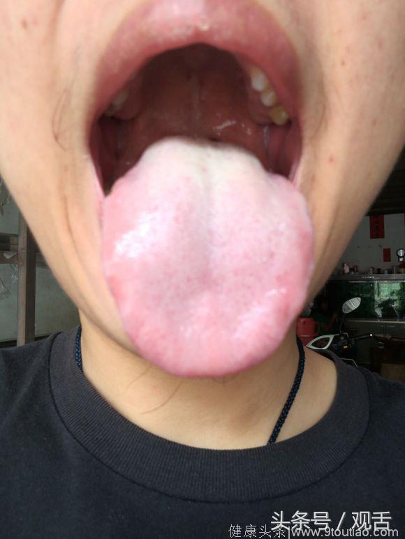 舌诊：寒湿内盛、脾胃虚寒、肝郁血瘀的舌照，看舌苔认识身体的状况！