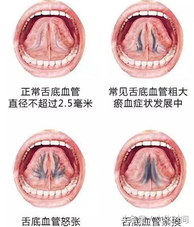中医技术：舌下取栓基础问答！