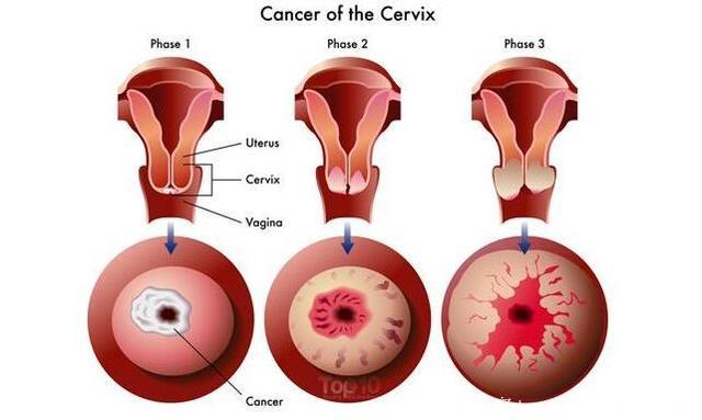 宫颈癌的10个警告标志，你不应该忽略！