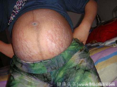 生完宝宝后肚皮又皱又丑，如何去除妊娠纹-必学