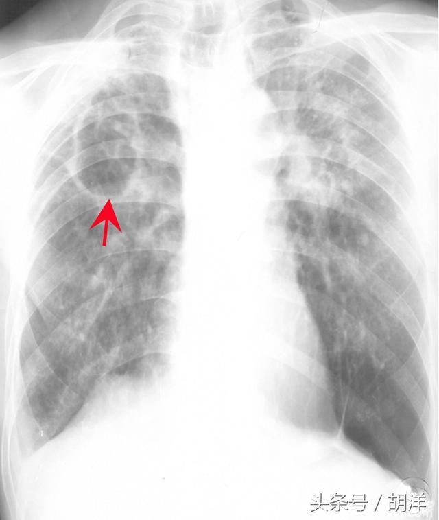 肺上长空洞，十洞七结核，两个是肺癌，一个是其他，简单介绍一下肺部空洞有哪些病