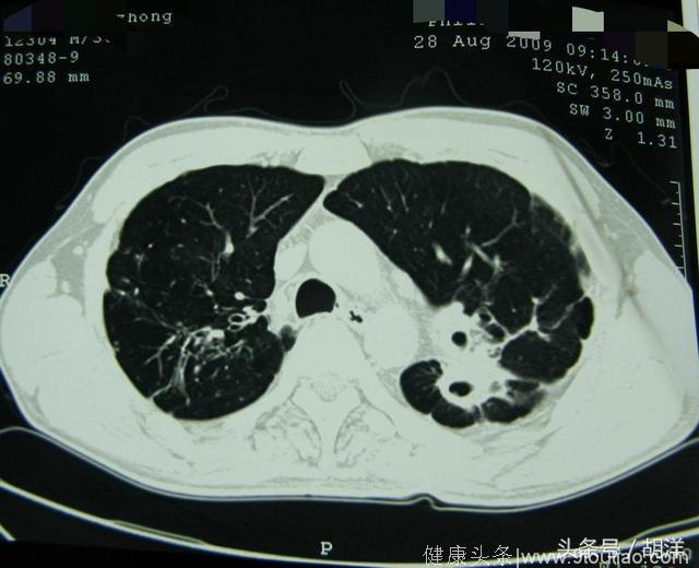 肺上长空洞，十洞七结核，两个是肺癌，一个是其他，简单介绍一下肺部空洞有哪些病