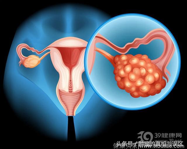 这两个信号一旦被错过，等着你的可能就是卵巢癌！