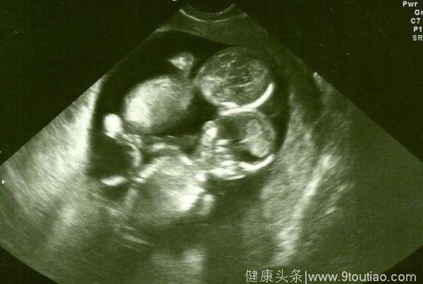 两年前怀上双胞胎，医生说连体，坚持生下来后意外获得惊喜