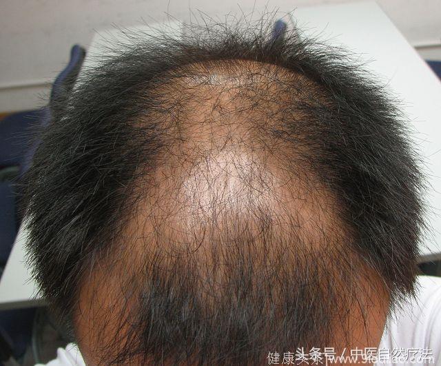 说几种常见的脱发类型，其中，头发黑者比少白头者爱脱发你知道吗