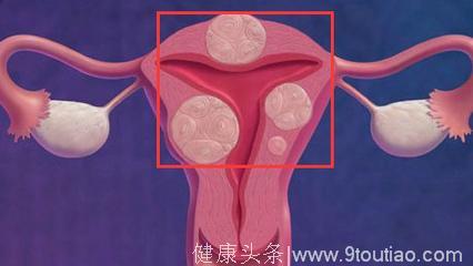 什么是子宫腺肌症？患有子宫腺肌症怎么办？