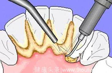 牙齿上出现“牙结石”有什么危害？选择这几样产品就能轻松去除