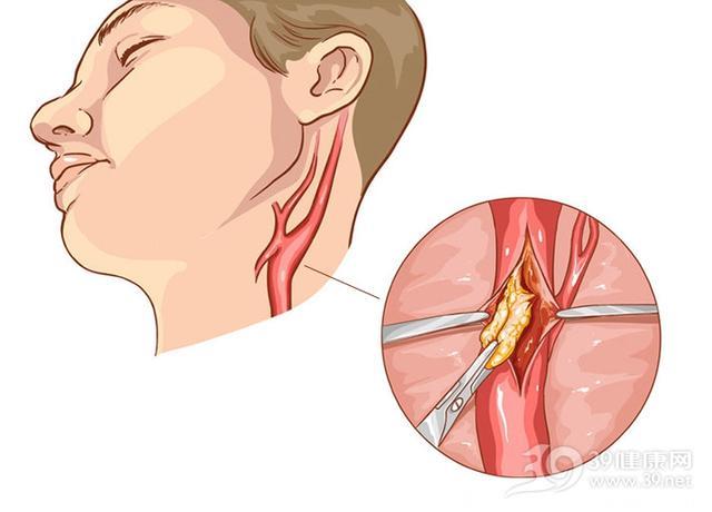 颈动脉斑块是脑卒中的“不定时炸弹”！一个检查可发现