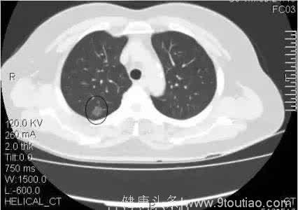 肺癌的检查有哪些？常见的有提示肺癌的检查