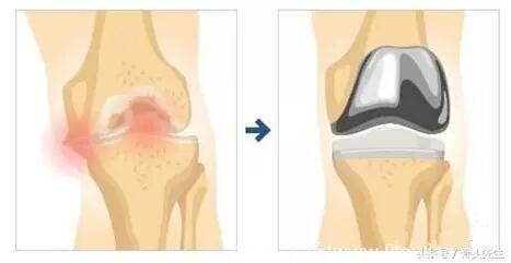 膝关节疼到底是什么原因？