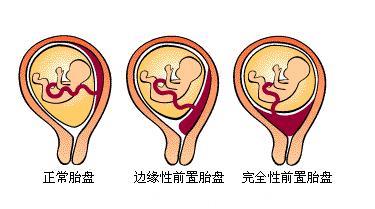 怀孕后，这4类女性容易出现前置胎盘！