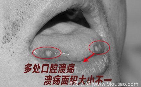 口腔溃疡总是反反复复，患了口腔溃疡究竟怎么办？