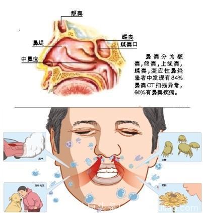 治疗鼻炎的几种小方法！