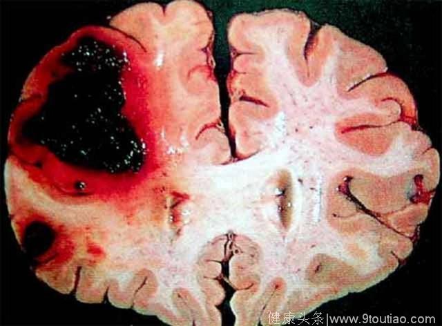 医生告诫：脑溢血病发前会有6个前兆，早期预防，或许可保命！