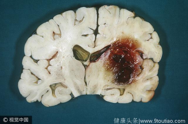 医生告诫：脑溢血病发前会有6个前兆，早期预防，或许可保命！