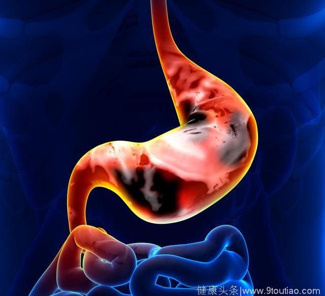 没有胃痛就不是胃癌？不一定，这5种症状可能是胃癌的征兆！
