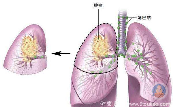 确诊肺癌晚期能活多久呢？
