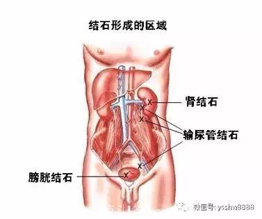 民间秘方如何根治肾结石（肝胆结石）