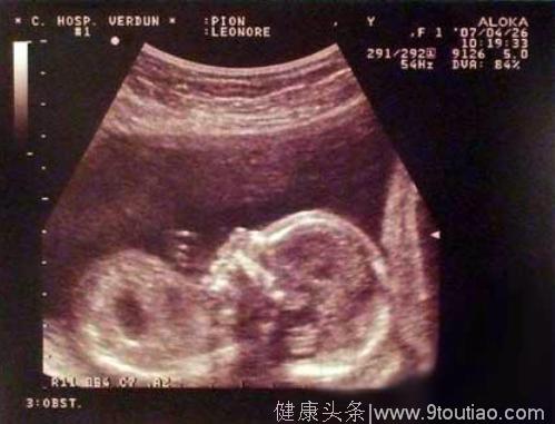 孕检显示双胞胎 生下宝宝的那一刻 全家人却绝望大哭！