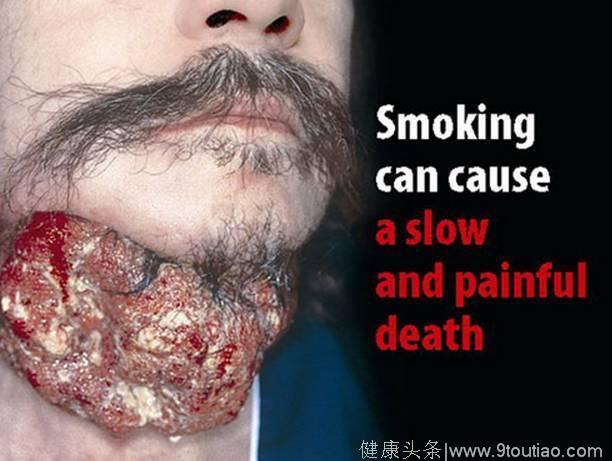 医生告诫：吸烟者容易忽视六个症状，这不是肺癌，小心要了你的命！