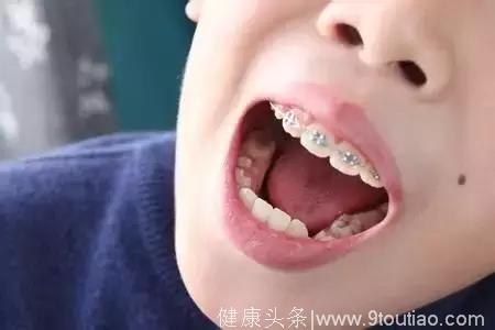 儿童牙齿矫正不容小觑