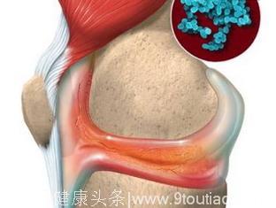 化脓性关节炎的其他感染因素是什么