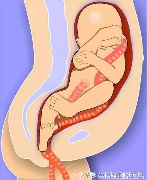 胎宝宝又调皮了，到了孕晚期还坚持臀位不转动，孕妈妈只能选择剖腹产了吗？