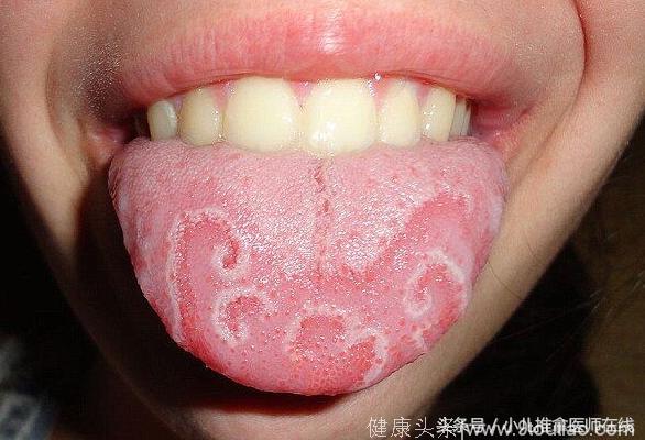 中医小儿推拿保健师：舌有花剥苔，名叫“地图舌”