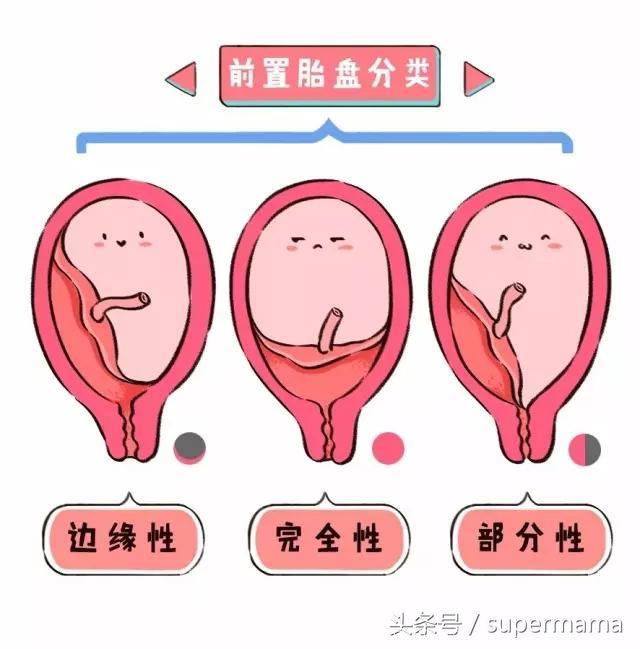 前置胎盘的孕妈，如果出现这几种症状，就要马上入院观察，遵医嘱
