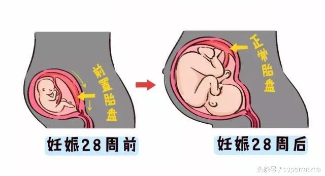 前置胎盘的孕妈，如果出现这几种症状，就要马上入院观察，遵医嘱