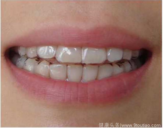 解密牙齿矫正的奥秘，哪一种才是最适合你的？