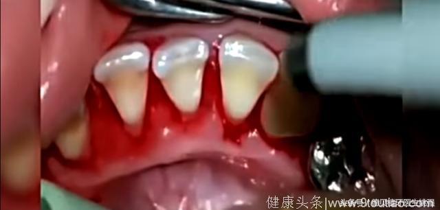 一口老牙全靠牙结石撑着？洗完之后齿缝就可以塞进一颗牙齿