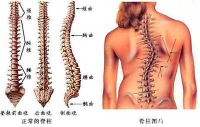 脊椎侧弯不仅体形不好看，还会引发肺功能障碍和心脏功能障碍，影响人的寿命，5个超简单的方法练起来