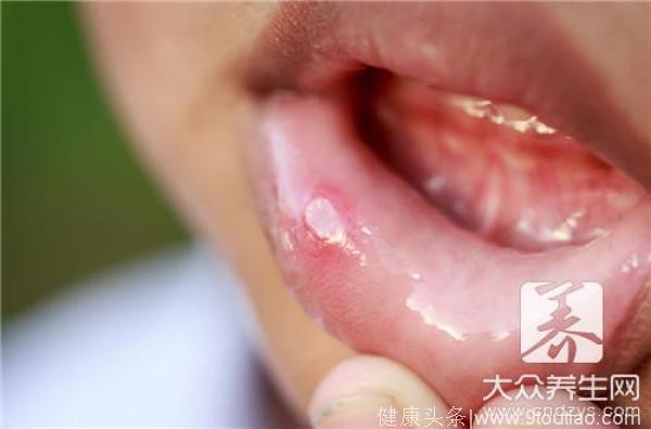 口腔溃疡几种快速有效的止痛方法