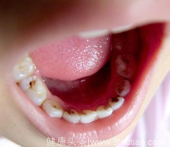 孩子长蛀牙怎么办？孩子龋齿（蛀牙）的食疗方法、饮食禁忌