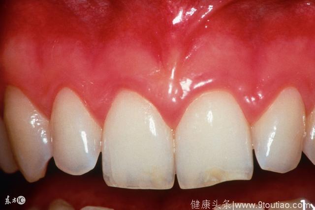 牙龈经常出血，是牙齿出了什么问题？