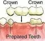 如何选择牙体缺损的修复方式？