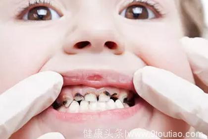 为什么孩子刚长的牙就蛀了？婴儿期口腔护理没做好，宝宝长坏牙！（内附婴儿口腔护理方法）