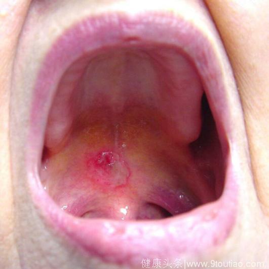 长期口腔溃疡就是癌症吗？主要看有没有这种现象出现
