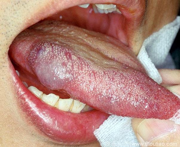 这3种口腔溃疡是舌癌的信号！花2分钟做一件事可阻断癌变