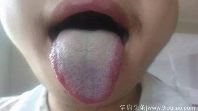 舌头出现这种情况，说明你的身体出现了问题