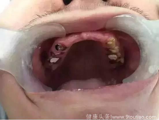 一个坏习惯导致19岁男孩牙齿全部烂掉，太可怕了！