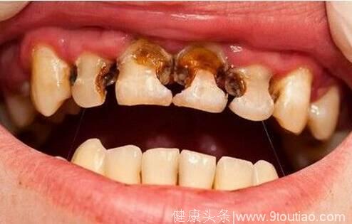 一个坏习惯导致19岁男孩牙齿全部烂掉，太可怕了！