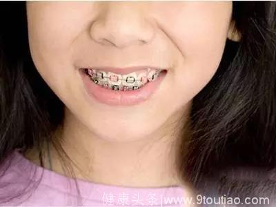 这些儿童牙齿矫正攻略，你知道多少？