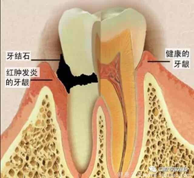 你出现过牙龈出血的情况吗，那是在提醒你应该关注口腔健康了！