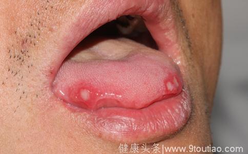舌头侧边长了两个凹下去的小颗粒，还有一层白白的膜，很疼，是啥？
