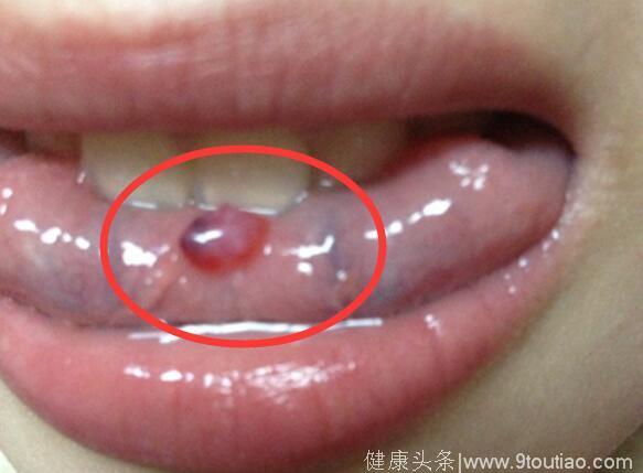 舌头上长了泡以为溃疡，不料是舌癌！舌癌早期有哪些症状？
