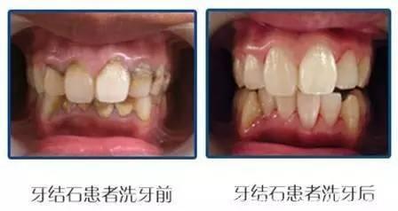 北大口腔：洗牙的误区——洗牙不等于牙齿美白