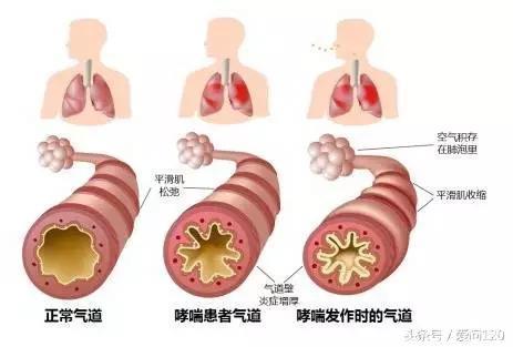 一图读懂支气管哮喘和急、慢性支气管炎的13大区别！