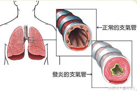 一图读懂支气管哮喘和急、慢性支气管炎的13大区别！